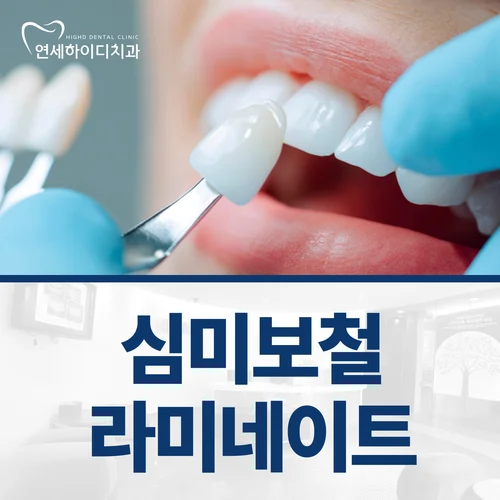 심미보철 라미네이트