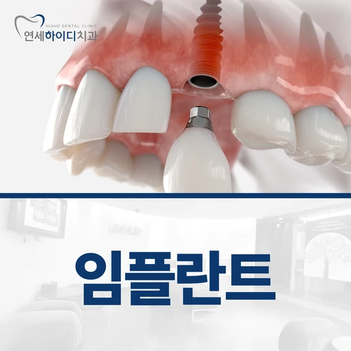임플란트
