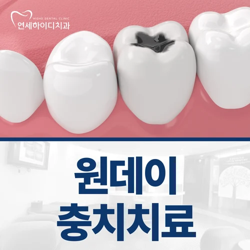원데이 충치치료